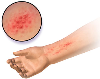 Dermatitis Dermatitis