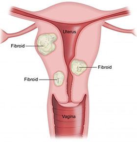 Fibroids Fibroids