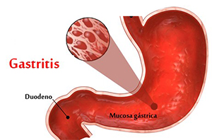 Gastritis Gastritis