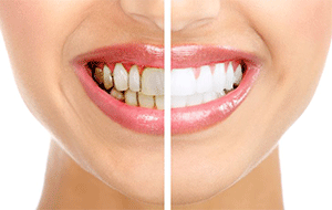 Gingivitis Gingivitis