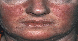 Primary Polycythemia Vera Primary Polycythemia Vera