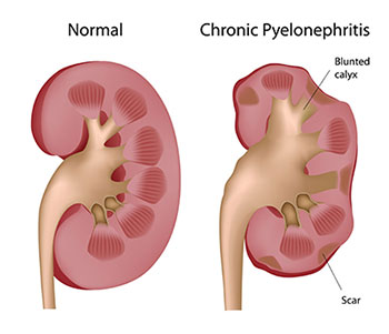 Pyelonephritis Pyelonephritis