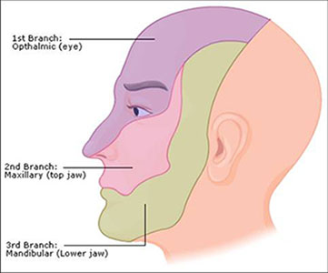 Trigeminal Neuralgia Trigeminal Neuralgia