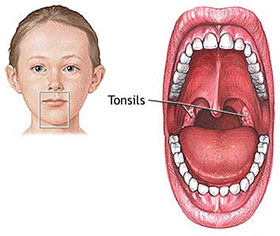 Tonsils Tonsillitis - How to get rid of tonsils fast in children