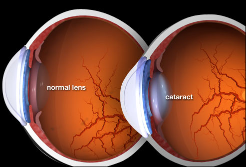 Cataract Cataract images - Ayurvedic Medicines for Cataract