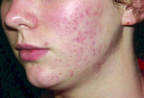 Acne Acne