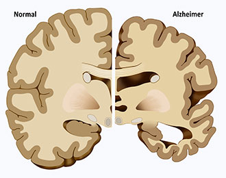 Alzheimer Disease Alzheimer Disease