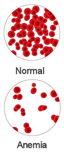Anemia Anemia