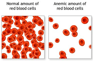 Anemia Anemia