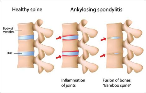 Ankylosing spondylitis Ankylosing spondylitis