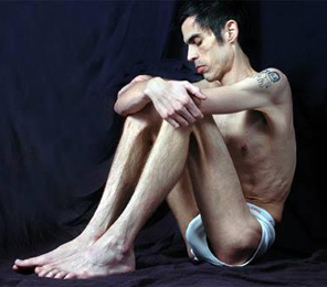 Anorexia nervosa Anorexia nervosa
