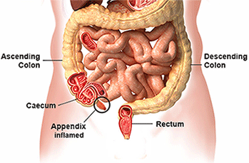 Appendicitis Appendicitis