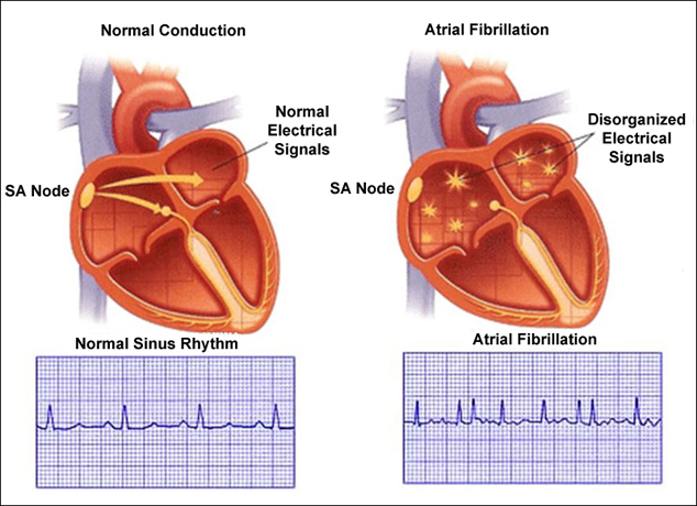Atrial Fibrillation Atrial Fibrillation