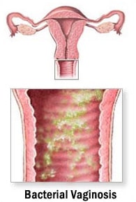 Bacterial vaginosis bacterial vaginosis