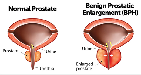 Benign prostatic hyperplasia Benign prostatic hyperplasia