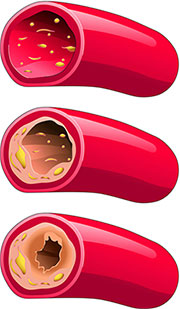 Blocked Arteries Blocked Arteries