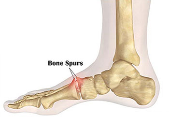Bone Spur Bone Spur