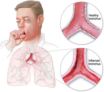 Bronchitis Bronchitis