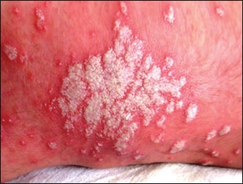 Candidiasis Candidiasis