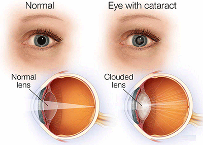 Cataracts Cataracts