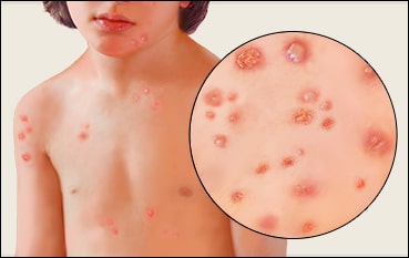 Chickenpox Chickenpox images