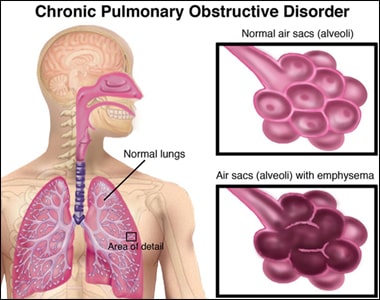 Chronic Obstructive Pulmonary Disease (COPD) Chronic Obstructive Pulmonary Disease (COPD)