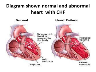 Congestive Heart Failure (CHF) Congestive Heart Failure