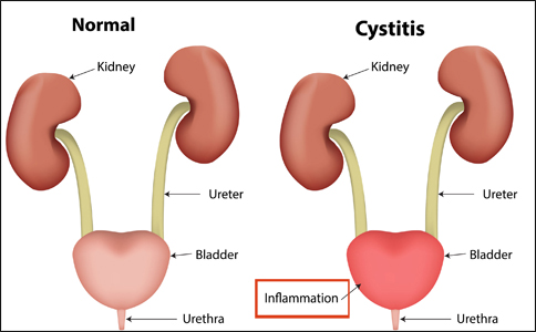 Cystitis Cystitis