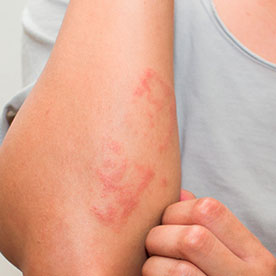 Dermatitis Dermatitis