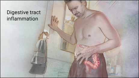 Diverticulitis Diverticulitis