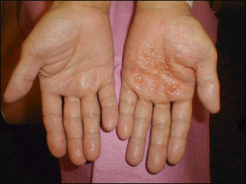 Dyshidrotic Eczema Dyshidrotic Eczema