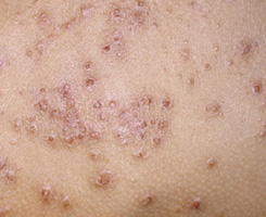Eczema Eczema