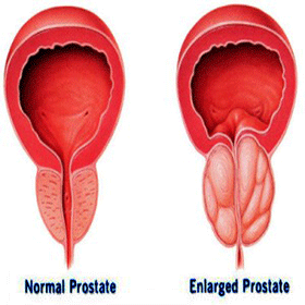 Enlarged Prostate Enlarged Prostate