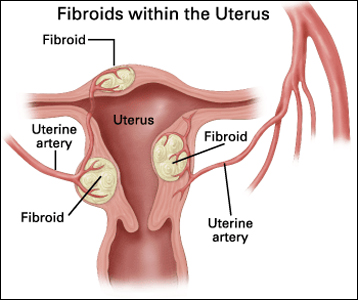 Fibroids Fibroids