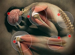 Fibromyalgia Fibromyalgia