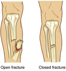 Fracture Fracture