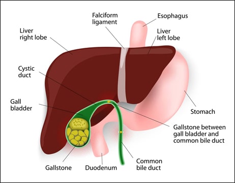 Gallstones Gallstones