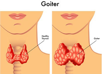 Goiter Goiter