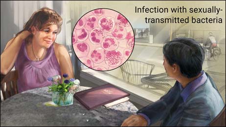 Gonorrhea Gonorrhea