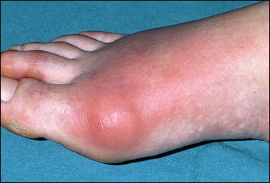 Gout Gout