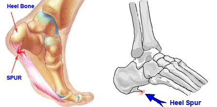 Heel Spur Heel Spur