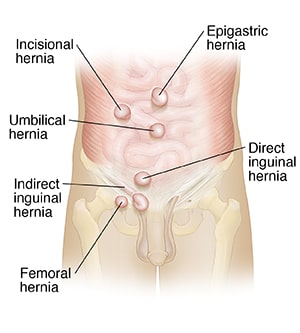 hernia treatment without surgery Hernia Treatment in Ayurveda