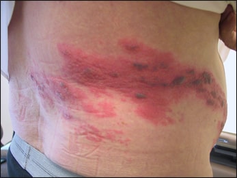 Herpes zoster Herpes zoster