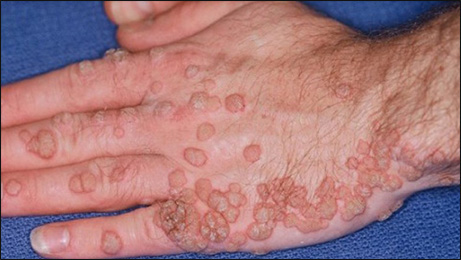 Human Papillomavirus Infection Human Papillomavirus Infection