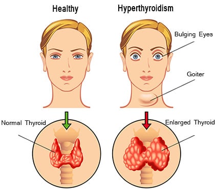 Hyperthyroidism Hyperthyroidism
