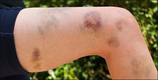 Idiopathic thrombocytopenic Purpura (ITP) Idiopathic thrombocytopenic Purpura, ITP