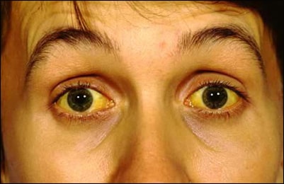 Jaundice Jaundice