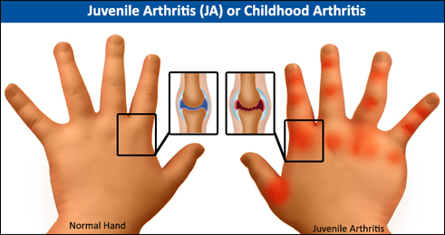 Childhood Arthritis (Juvenile Arthritis) Childhood Arthritis, Juvenile Arthritis