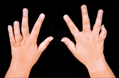 Juvenile Rheumatoid Arthritis (JRA) Juvenile Rheumatoid Arthritis (JRA)