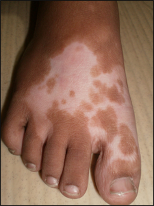 Leucoderma Leucoderma